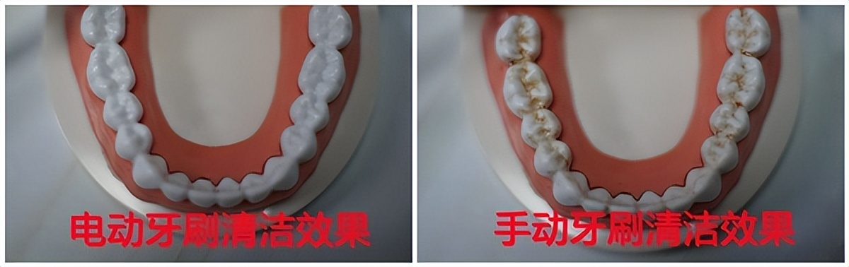电动牙刷弊端,儿童电动牙刷u型好还是普通的好