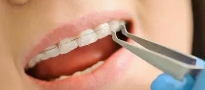 明明很小心，为什么托槽还是老掉？专家分析：问题出在这