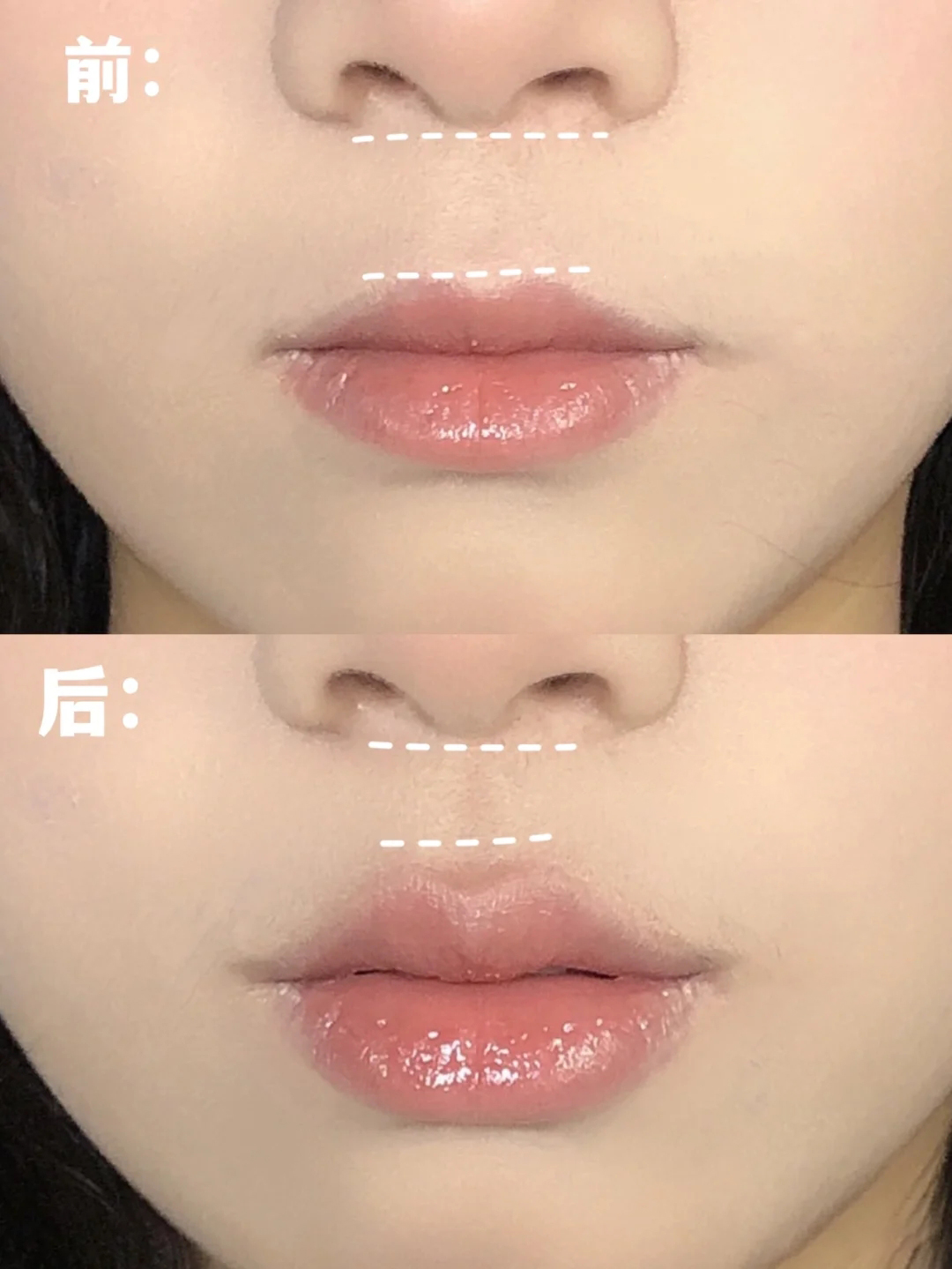 凸嘴矫正可以缩短人中吗,人中太长凸嘴怎么化妆缩短