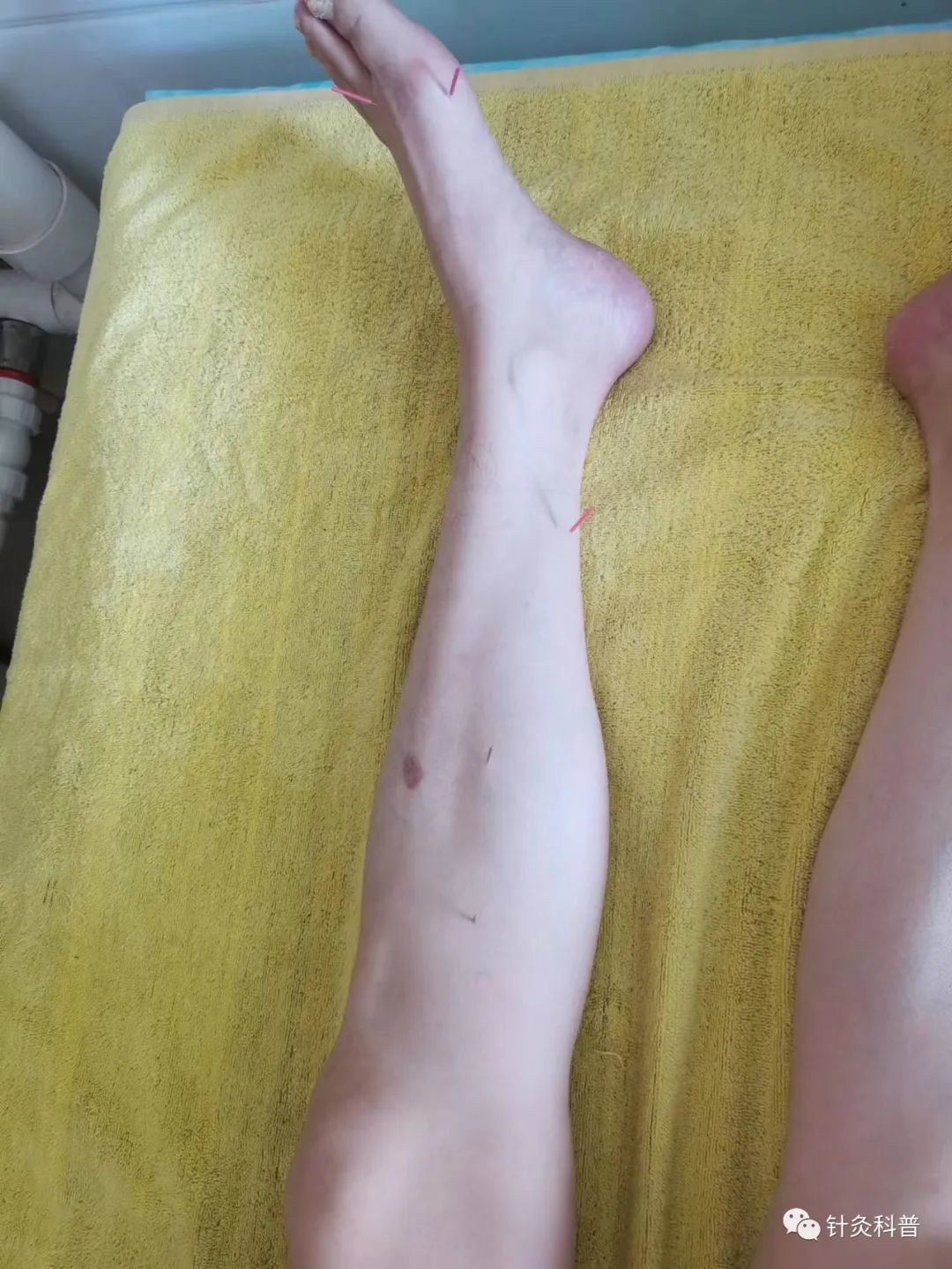 董氏针灸治肾病综合征处方,肾病综合征针灸