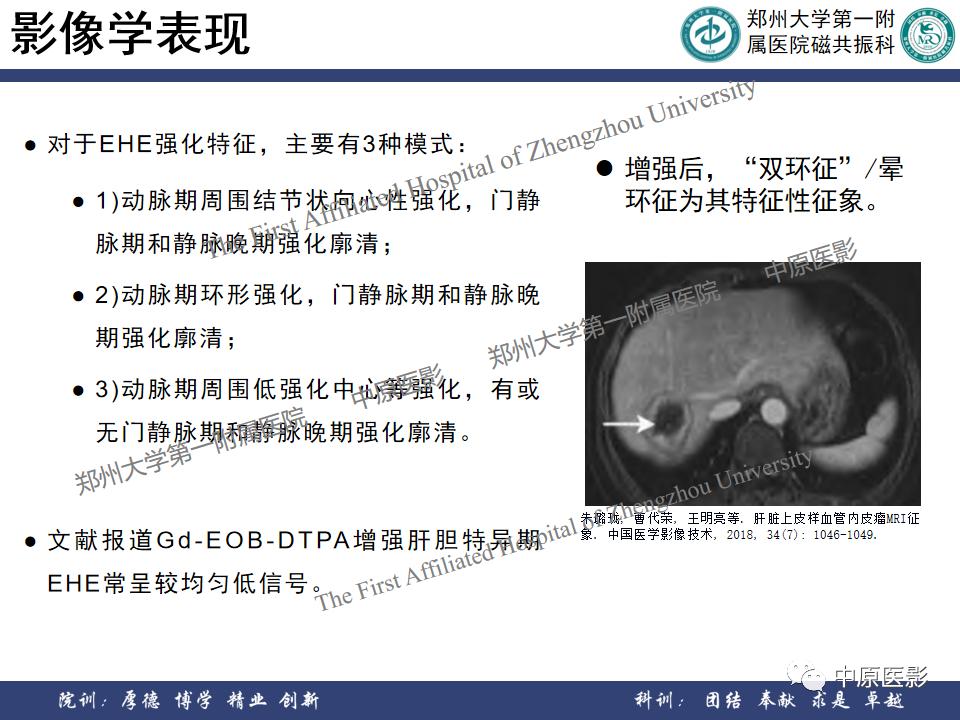肝脏血管瘤样本,正确认识肝脏血管瘤文章