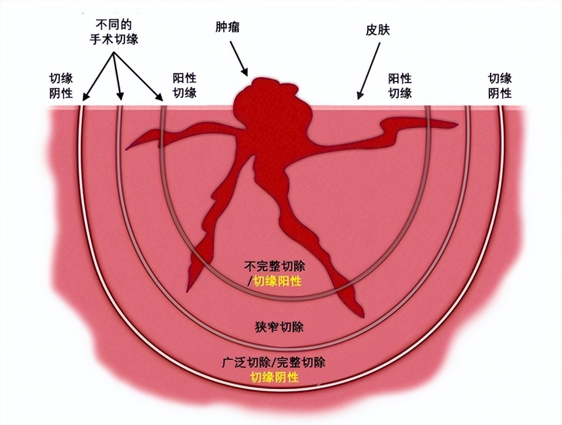 胃癌中晚期恶性肿瘤怎么治疗好,恶性程度低的胃癌