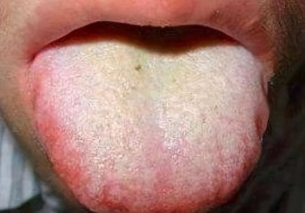 吃了补气血的中药一直上火怎么办,气血虚吃了中药上火咋办