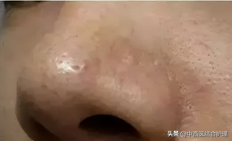 背后长许多小米粒应该怎么做,后背小米粒祛除过程