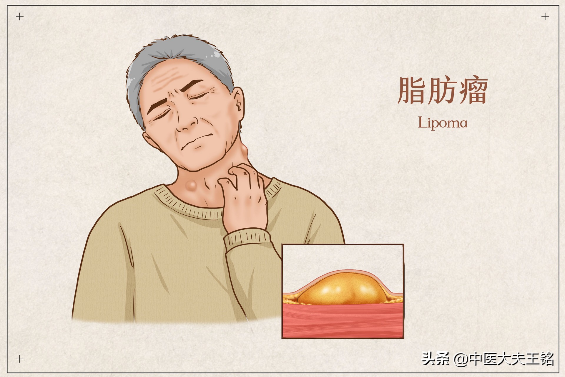 大腿手臂长疙瘩是怎么回事,胳膊和腿上长了肉疙瘩怎么回事