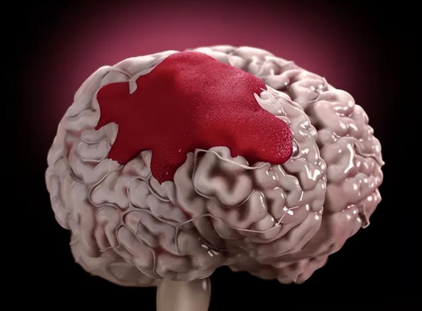 脑萎缩病人很担心,哪种药用来治脑萎缩