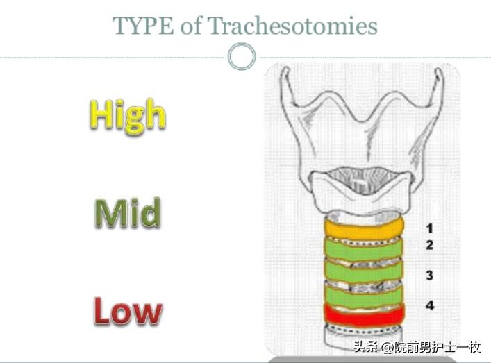 关于气管切开技术流程及注意事项