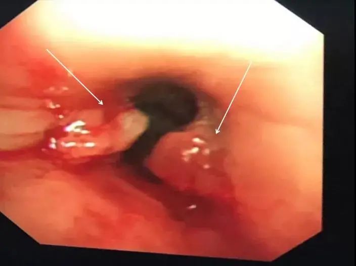 喉管长了一个包怎么办,气管里总长痰栓怎么治疗