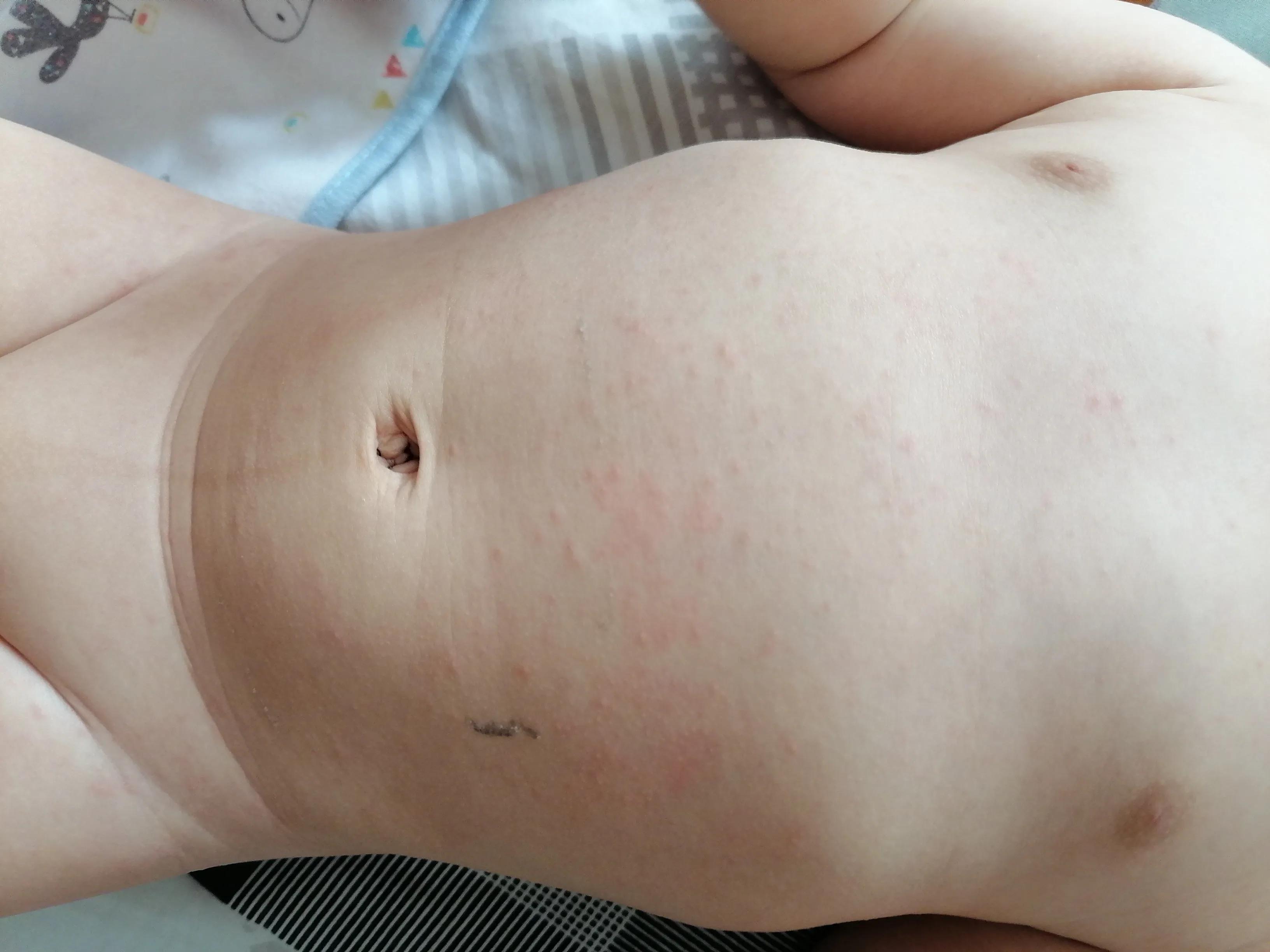 宝宝急疹一般几天痊愈,9个月宝宝幼儿急疹高热怎么喂药