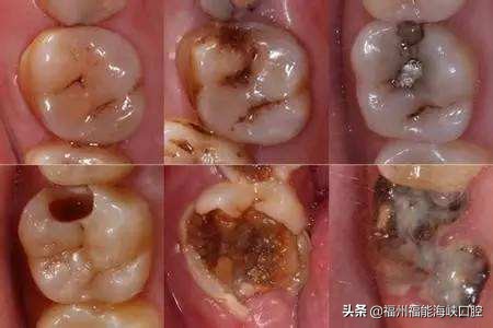 补牙太便宜怎么办,补牙太贵了怎么办