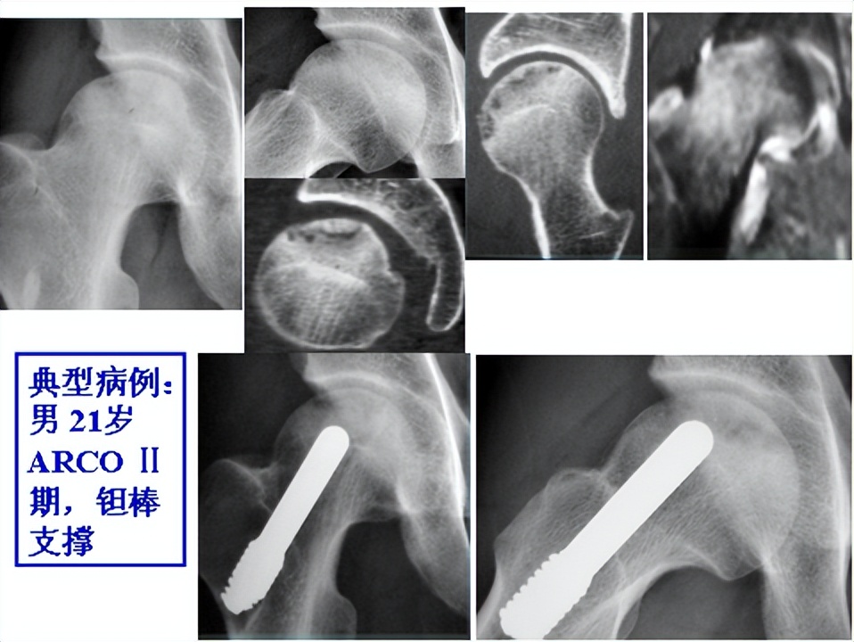 股骨头坏死保髋微创手术成功率,髋部骨头坏死微创手术康复训练