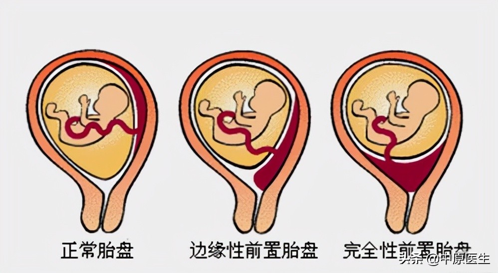 女子难产输血6000毫升,女子剖腹产出院产后大出血