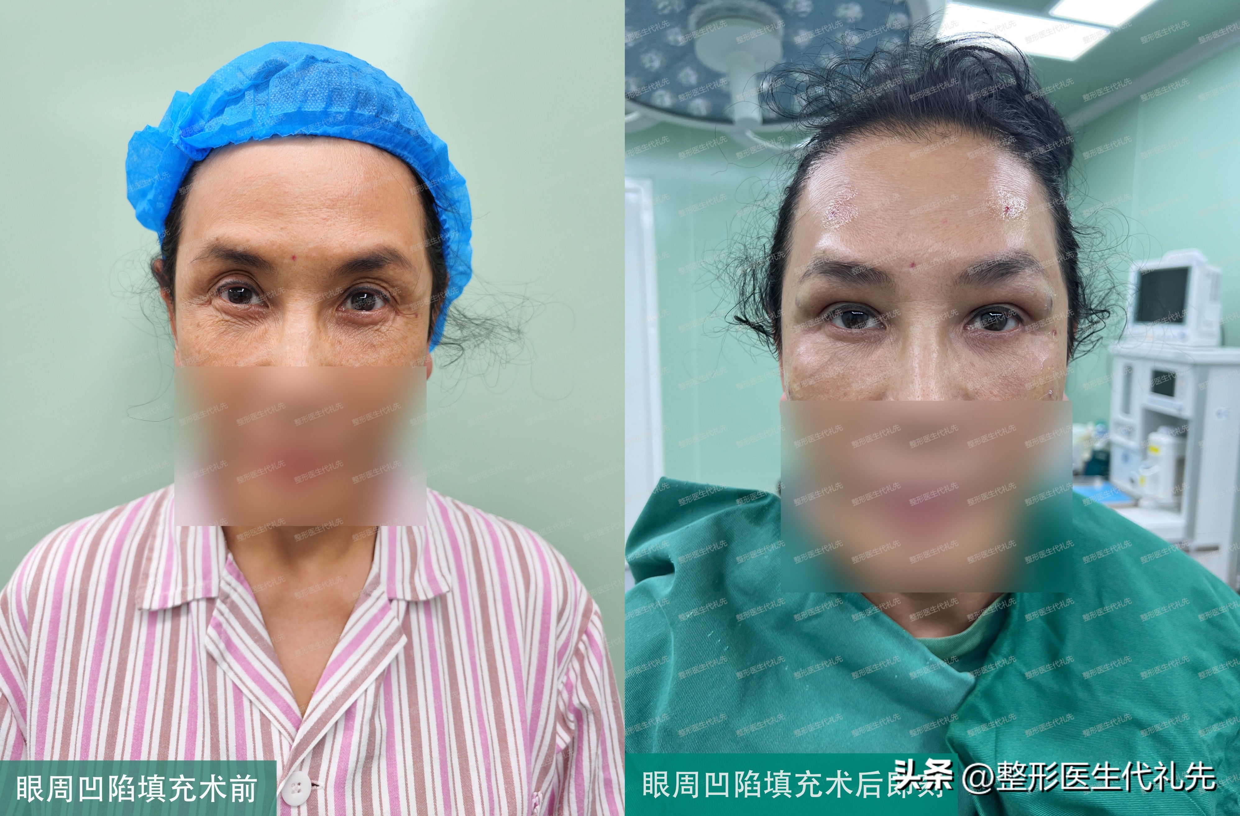 眼窝凹陷填充后眼睛变小,眼部凹陷怎么变饱满填充