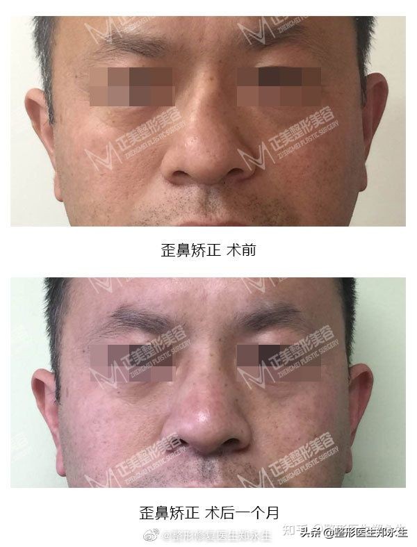 截骨歪鼻矫正术多少钱,歪鼻矫正必须要截骨吗