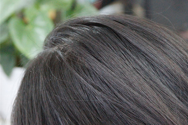 头皮屑大块大块的掉应该怎么治疗,头皮屑大块掉什么原因造成的