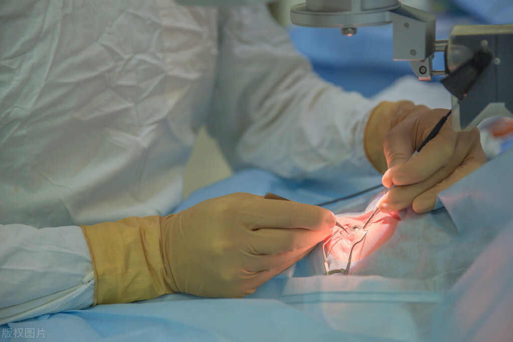 上海眼科院长科普：白内障手术安全吗？做手术会引发并发症吗？