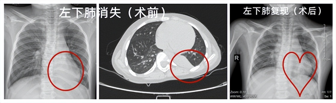 9岁孩子肺部长出“小树苗”，这种疾病要尽早发现尽早治疗
