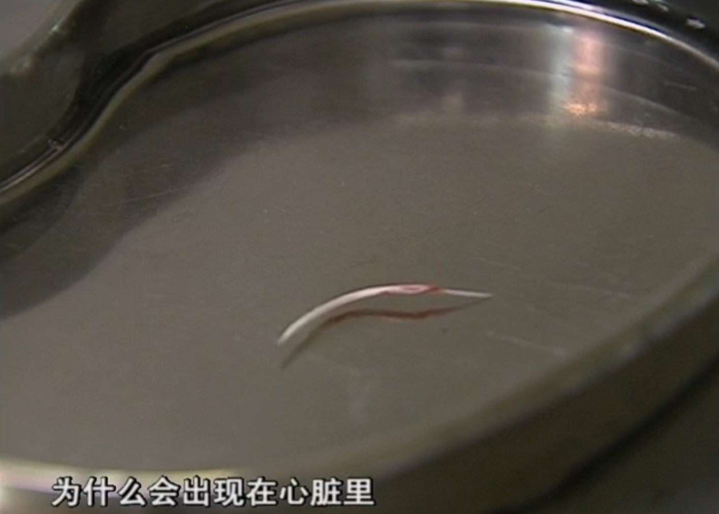 2010年,厦门小伙连续3月反复高烧,医生打开心脏夹出3厘米的鱼刺