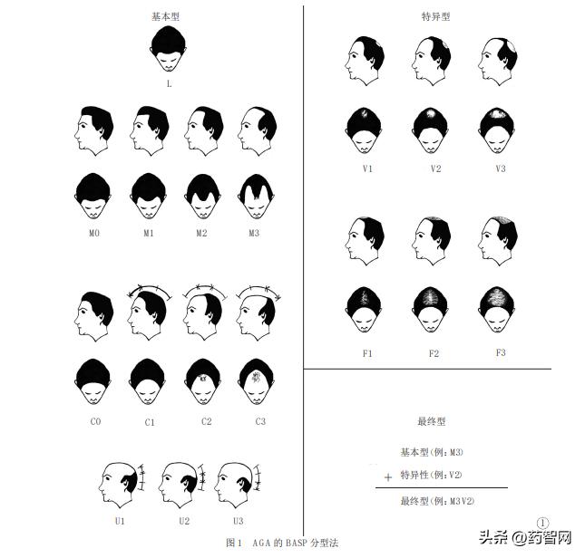 3款上市、18款在研，雄激素性脱发药物分析