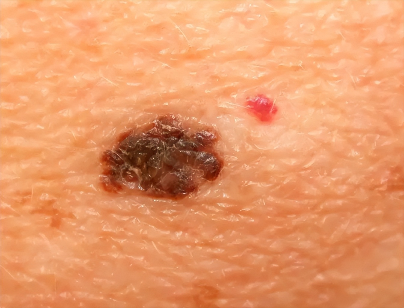 一旦皮肤上长了这5种痣,十有八九是黑色素瘤,一拖再拖会很麻烦