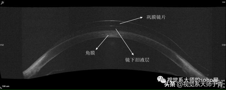 巩膜镜的验配技巧及案例分享,试戴巩膜镜成功率高不高