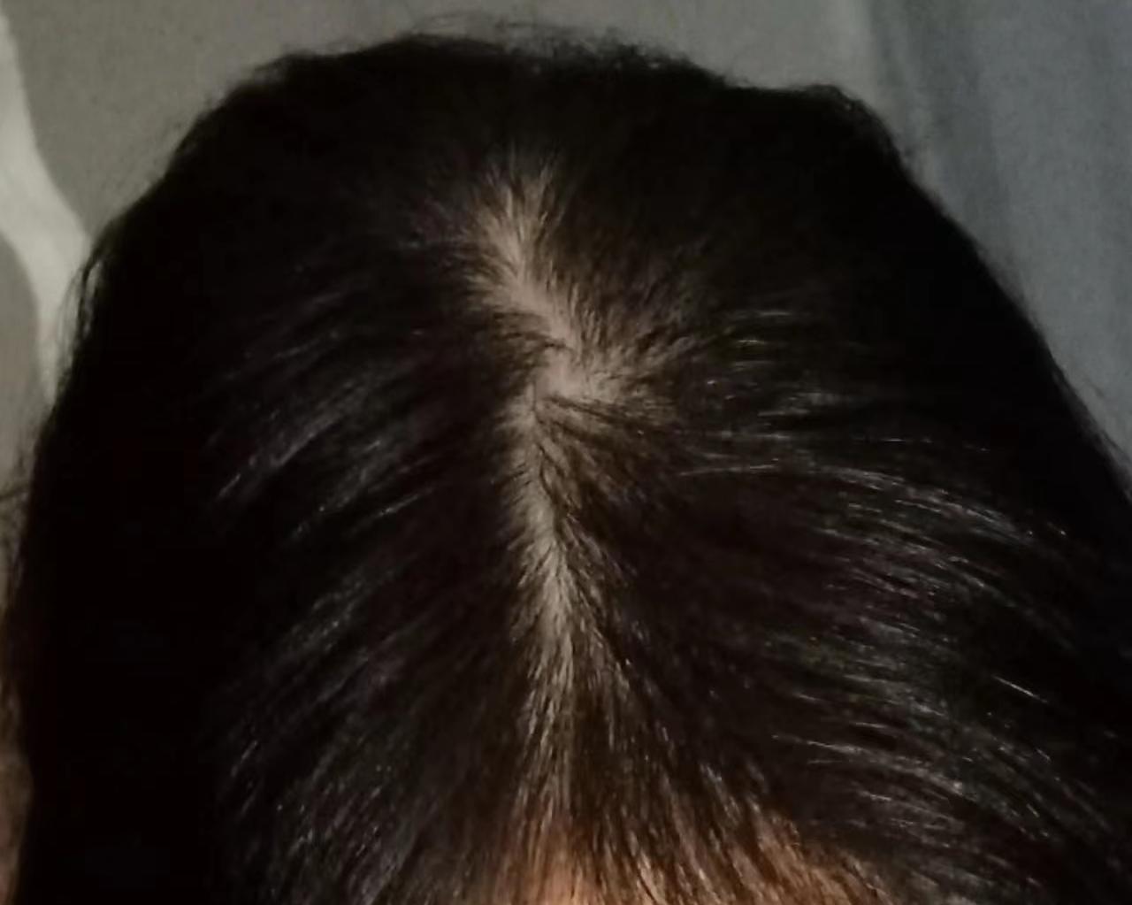 米诺地尔狂脱期前后对比,亲身经历米诺地尔的狂脱期