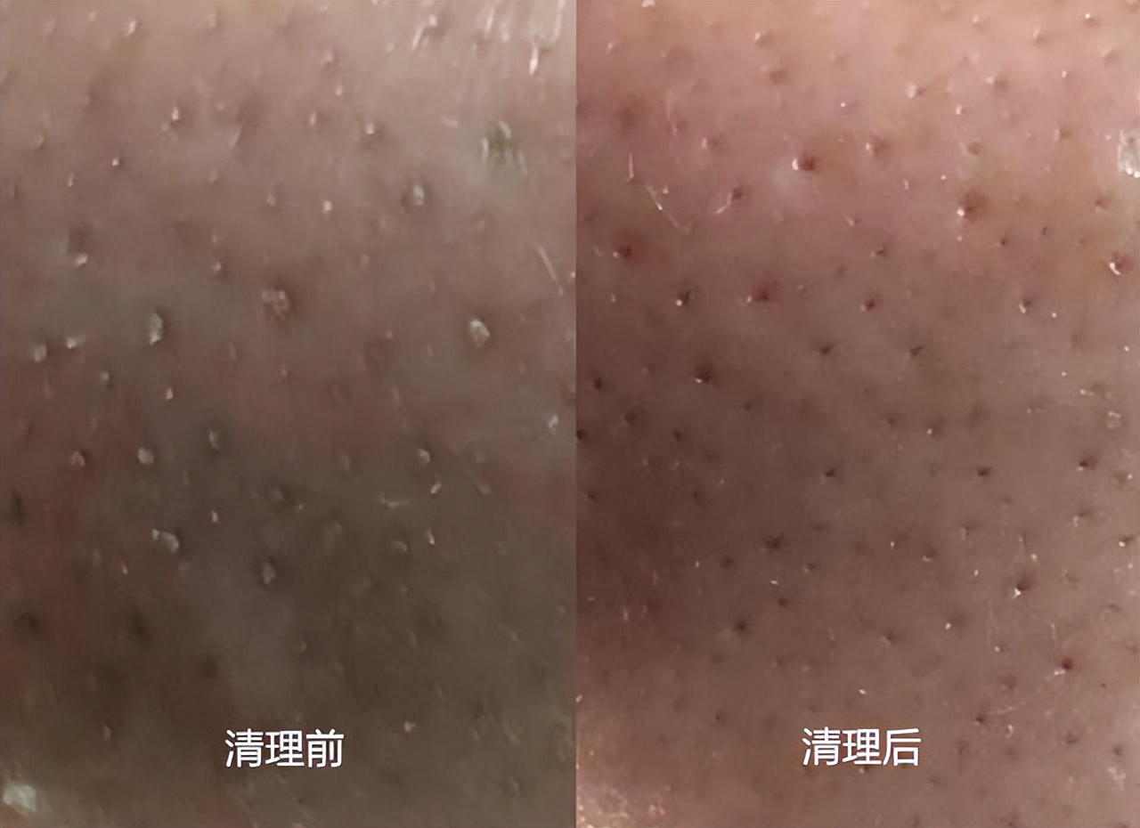 为什么鼻子可以挤出很大的黑头,用夹子挤出鼻子黑头