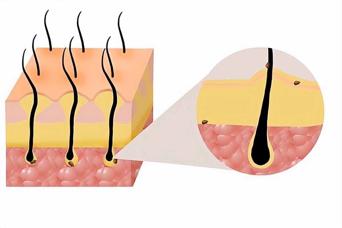 阴虱是什么？为什么现在很多人得阴虱？医生：离不开3个传播途径