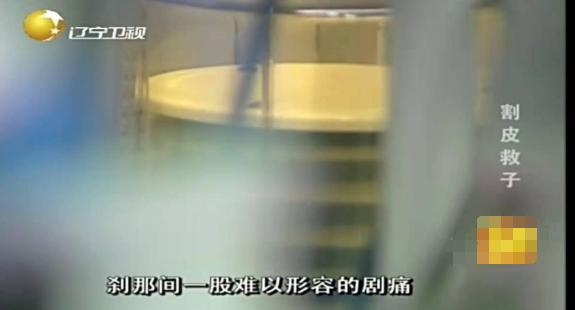 切肤之爱真实上演，河北妈妈割皮救子，就算割光全身的皮也不怕
