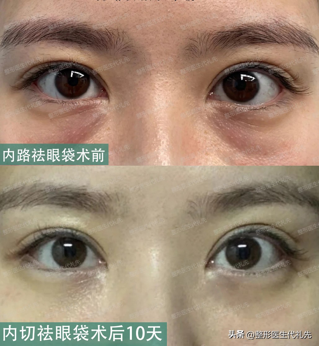 眼袋形成的真正原因,眼袋是怎么形成的去除眼袋的方法