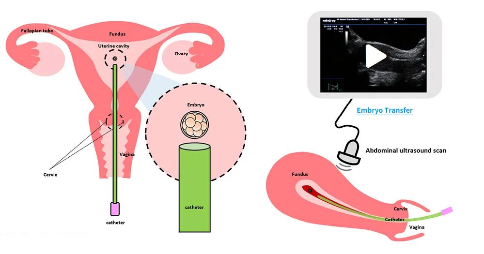 试管婴儿|胚胎移植后这样做保胎更有效！