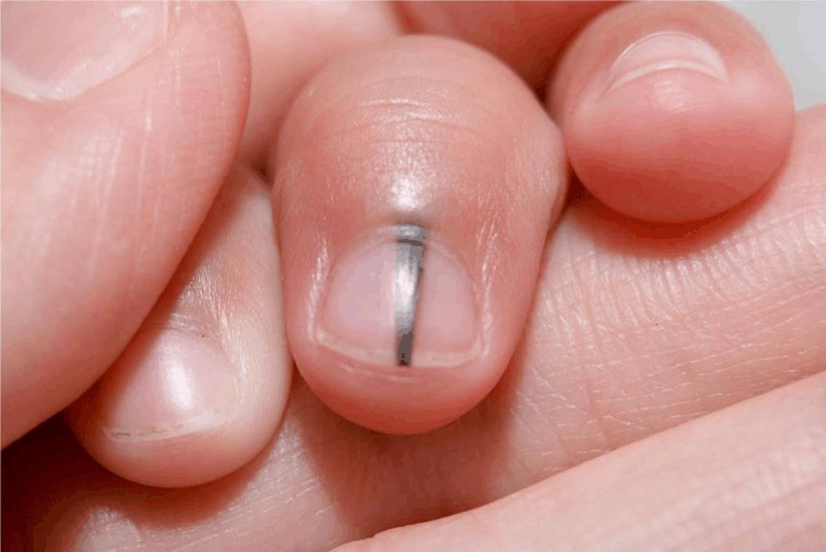 指甲上有五种疾病征兆,小指甲竖纹是身上哪个部位有疾病