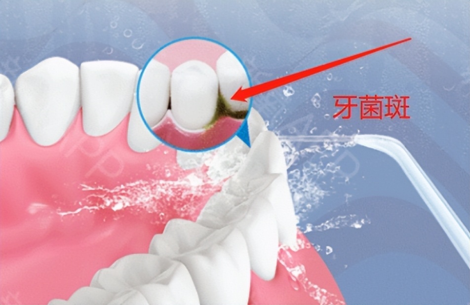 漱口水对口臭真的有用吗,一次性漱口水杀菌除口臭怎么用