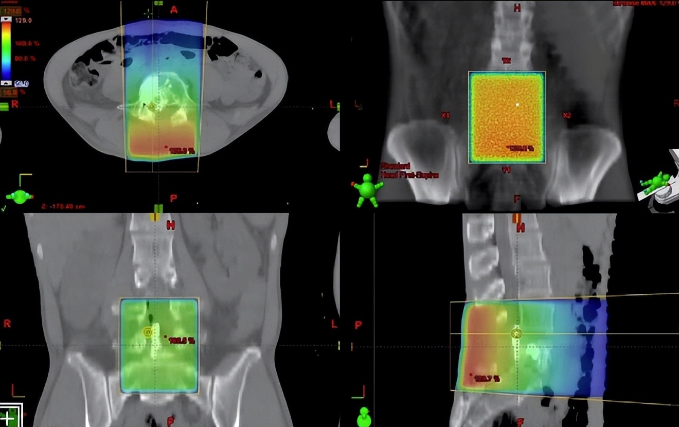 肺癌晚期骨转移止痛药哪种最止痛,癌症骨转移止痛药非处方有哪些
