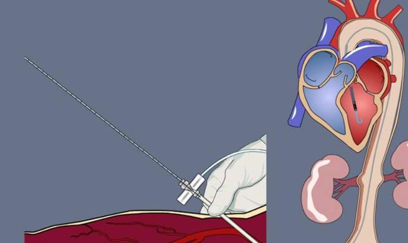 强生史上最大收购后，心衰赛道迎来新变数