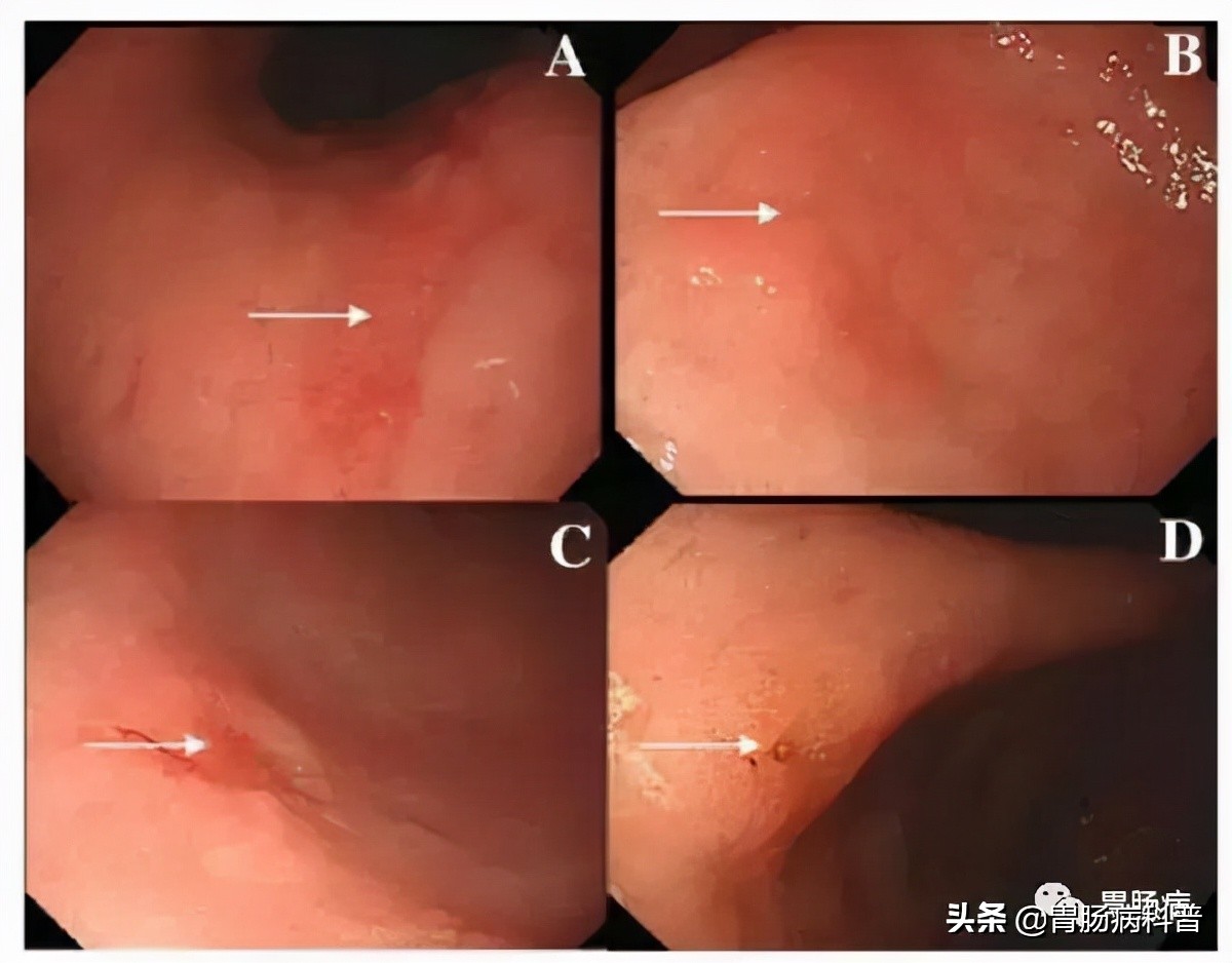 萎缩性胃炎C3伴肠化癌变几率,萎缩性胃炎一定癌变吗