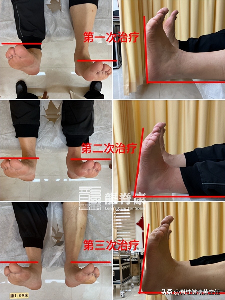 崴脚之后没有恢复好怎么办,崴脚5个月了还未消肿痊愈