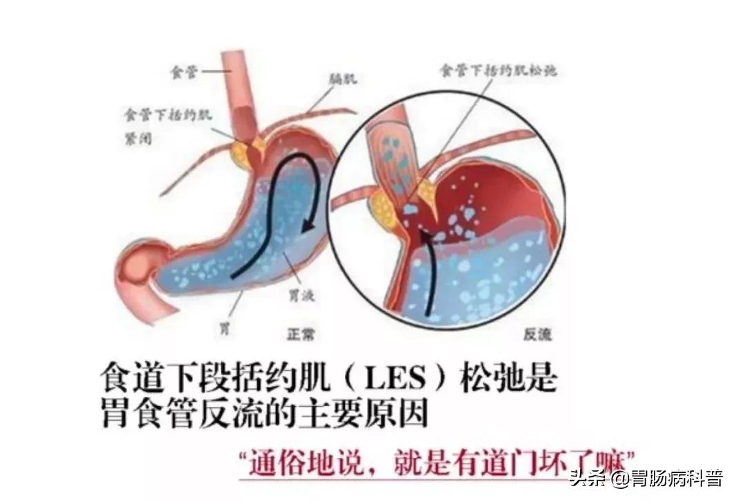 最新研究：总是烧心怎么办？专家建议了5种生活方式