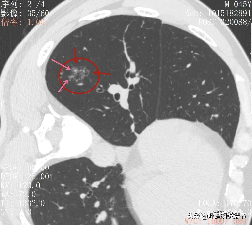 肺蜂窝状改变是肺癌吗,肺部陈旧灶与肿瘤怎么确诊