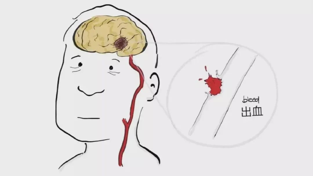 玩剧本杀被吓到脑出血是什么剧本,玩剧本杀玩出脑出血