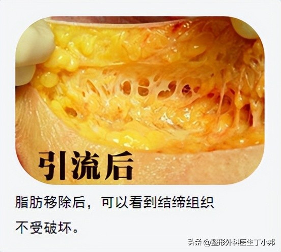 丁小邦博士介绍,整形医生丁小邦线雕