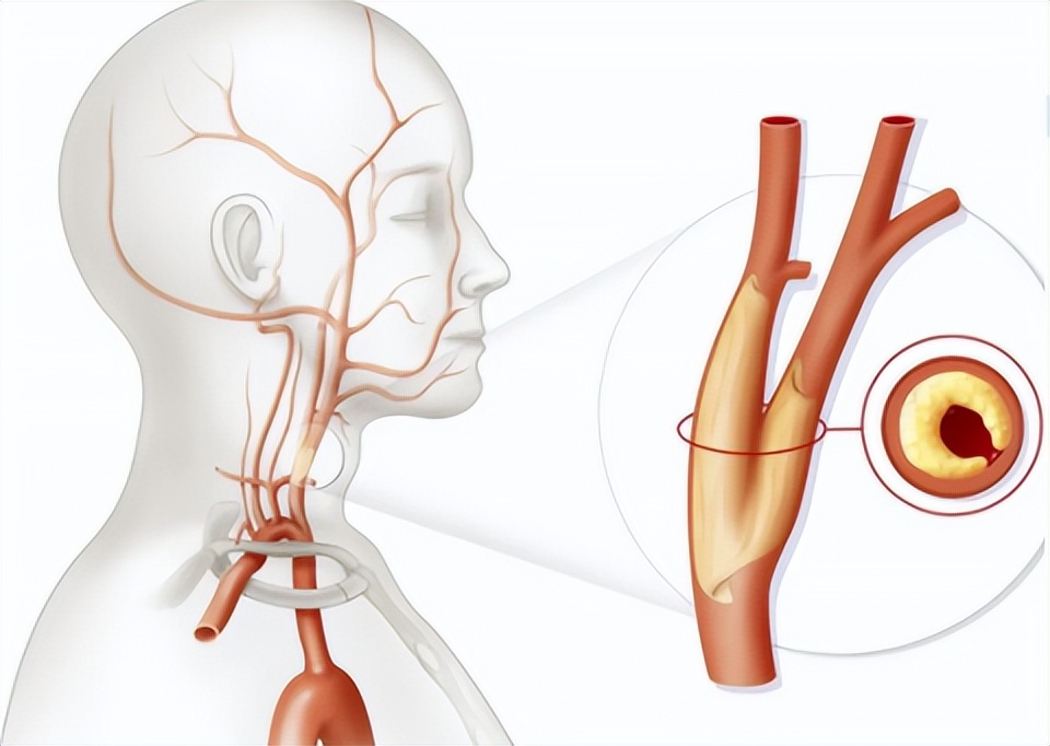 导致颈动脉血管狭窄的原因,颈动脉狭窄吃什么食物好
