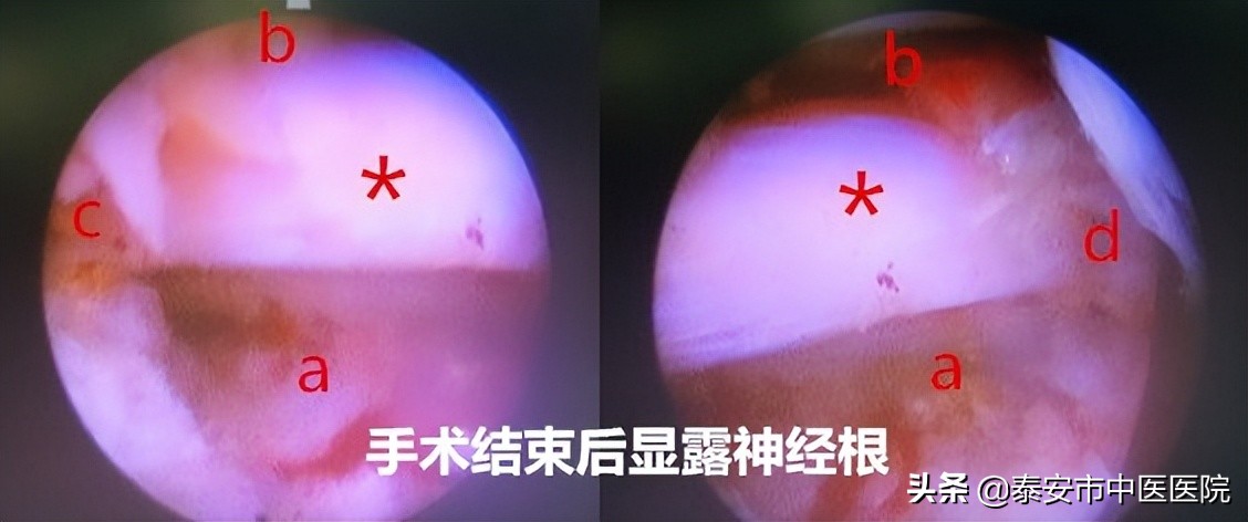 【中医特色，治骨疗伤】铁骨铮铮“脊”往开来——记*安泰**市中医医院（*安泰**市骨伤医院）脊柱外科