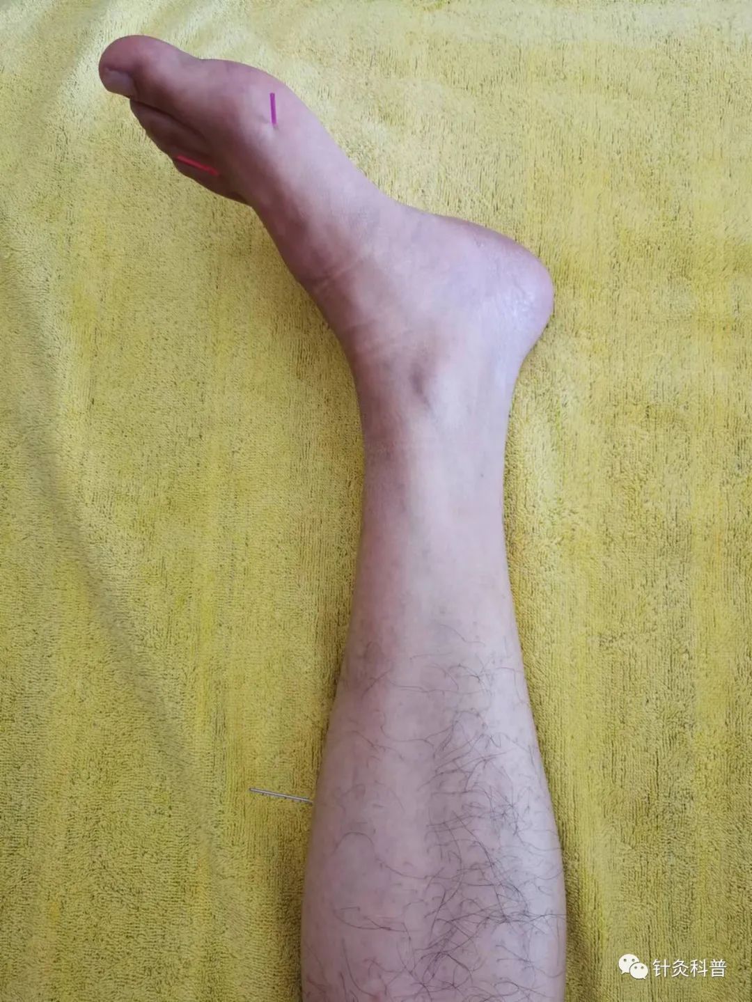 针灸治疗偏头痛的经方,针灸后偏头痛是怎么回事