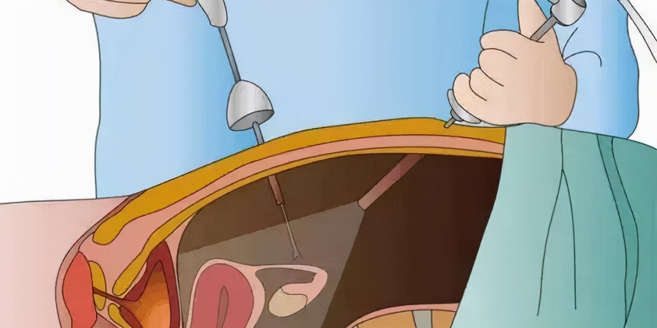 长沙输卵管复通费用,贵州省输卵管复通手术费用