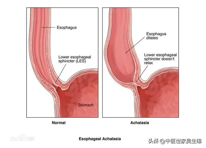甘麦大枣汤治口吃,甘麦大枣汤治疗干燥综合征