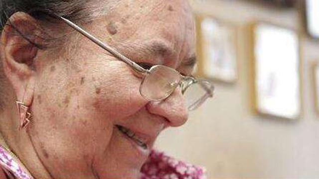 红霉素淡化老人斑的办法,老人斑去除方法红霉素