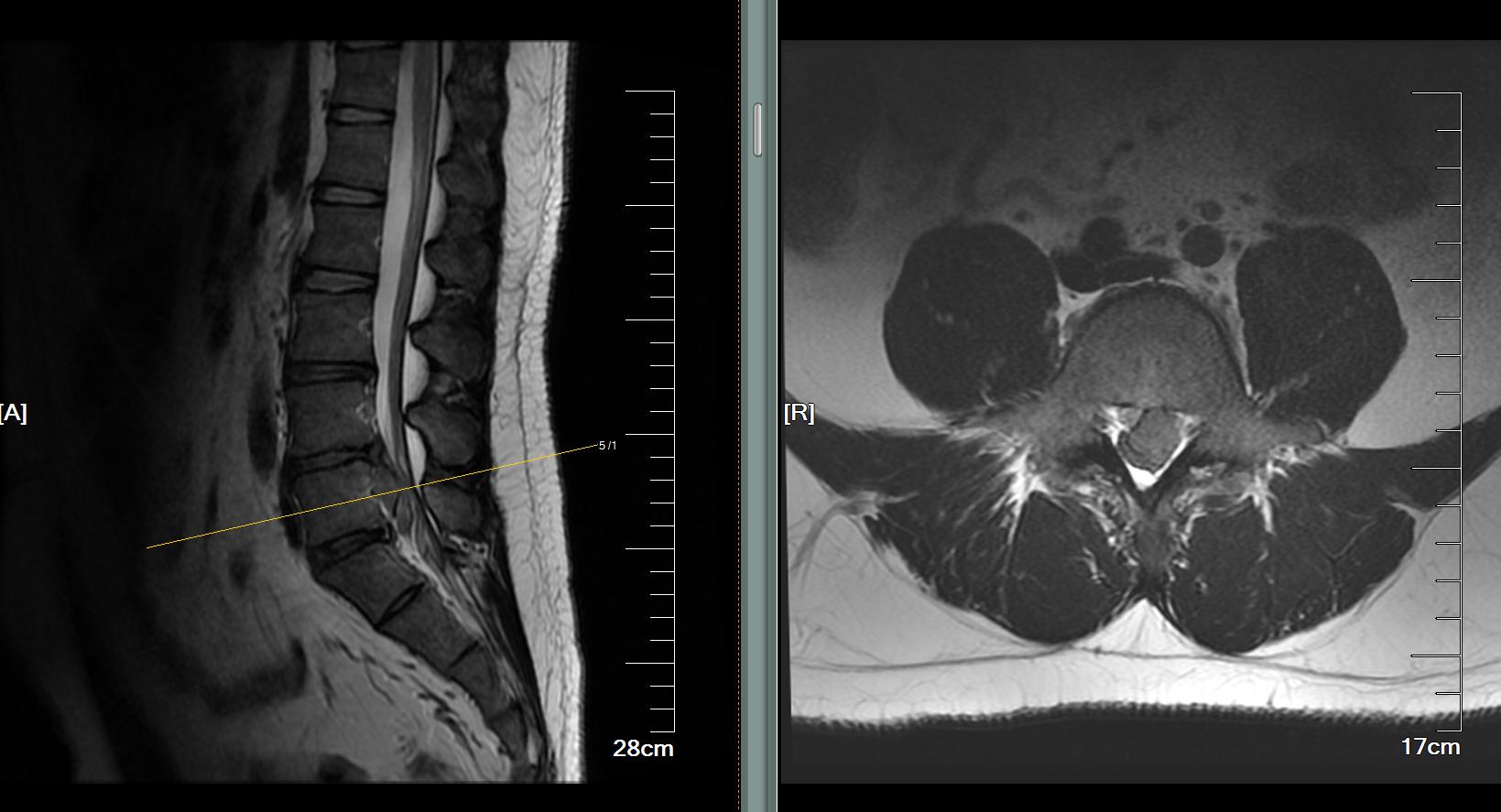 腰椎间盘突出最好的保守治疗方法,腰椎间盘突出没有根治的药方吗