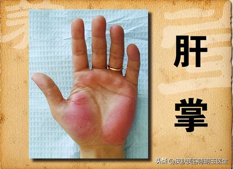 皮肤长红痣是肝有毛病,身上长出红痣是肝脏出了问题吗