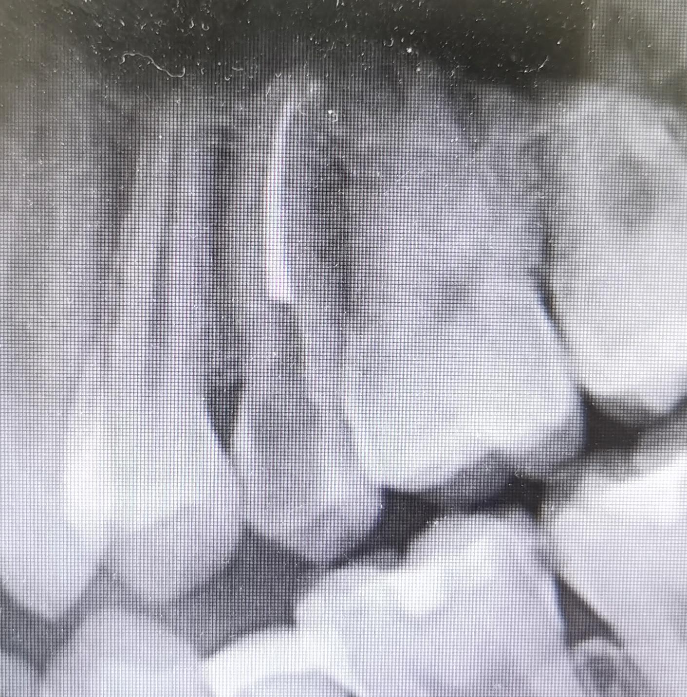 蛀牙不治疗的发展历程,蛀牙一直不治疗